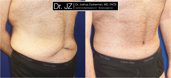 Right oblique view of a body contouring (post weight loss surgery) patient. Dr. Zuckerman performed a tummy tuck after this patient had previously lost 100lbs. Images taken before surgery and three months post-op.