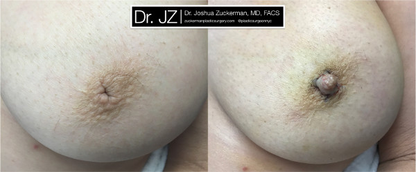One of Dr. Zuckerman’s inverted nipple surgery outcomes. Images were taken before the procedure and immediately postop.