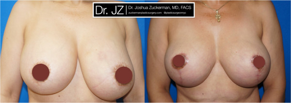Frontal view of a before and after of breast augmentation and mastopexy revision surgery Dr. Zuckerman performed. Patient was unhappy with asymmetry from a previous cosmetic surgery procedure, which had also damaged her left nipple. Images taken before surgery and one month after surgery.