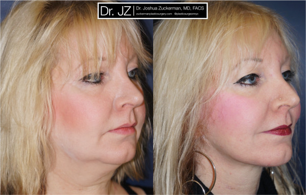 Right oblique view of one of Dr. Zuckerman’s facelift patients. Images were taken before surgery and one year after surgery.