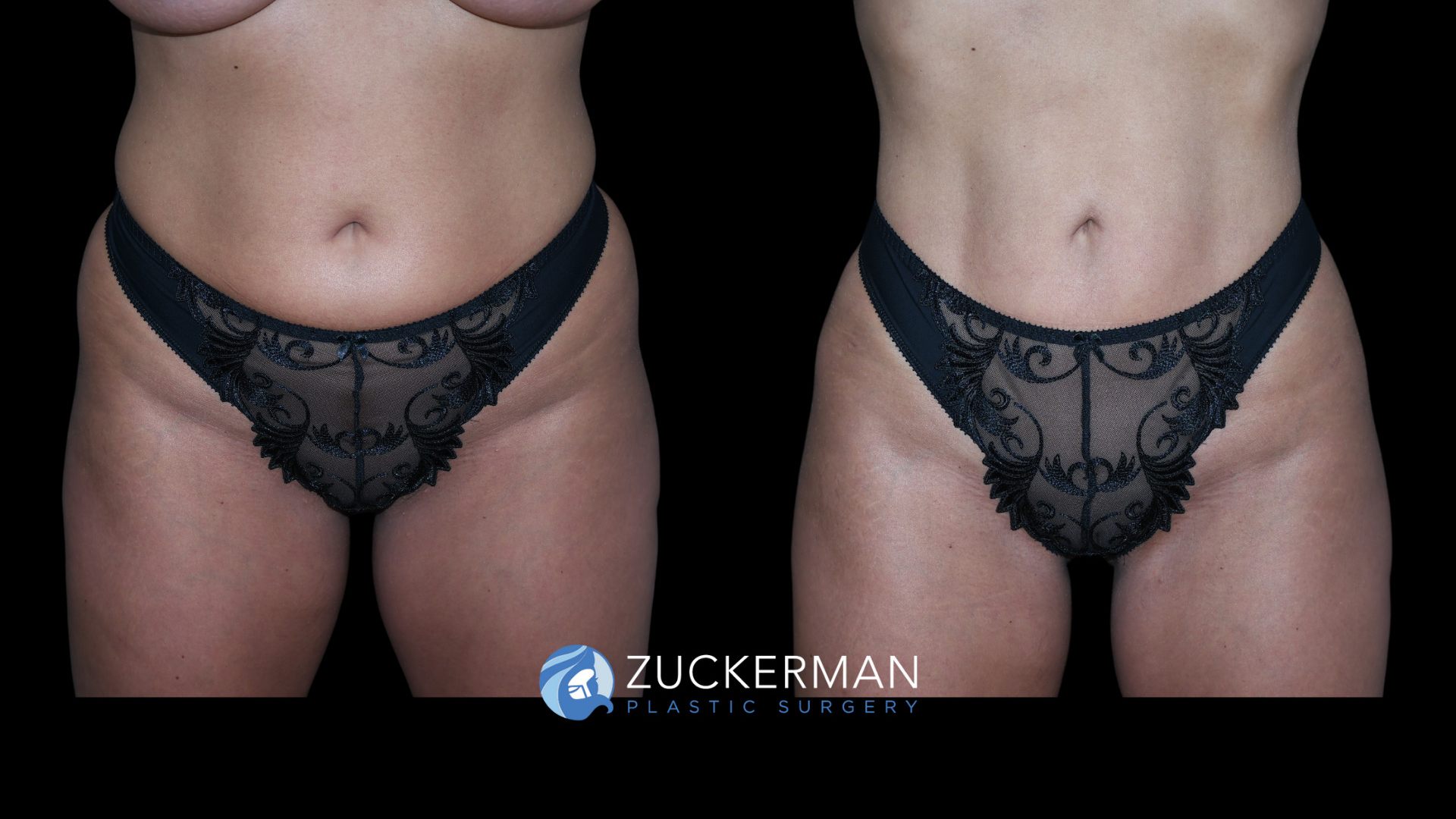 Patient before and after Lipo 360: Liposuction of Abdomen, Flanks, & Lower Back | Zuckerman Plastic Surgery