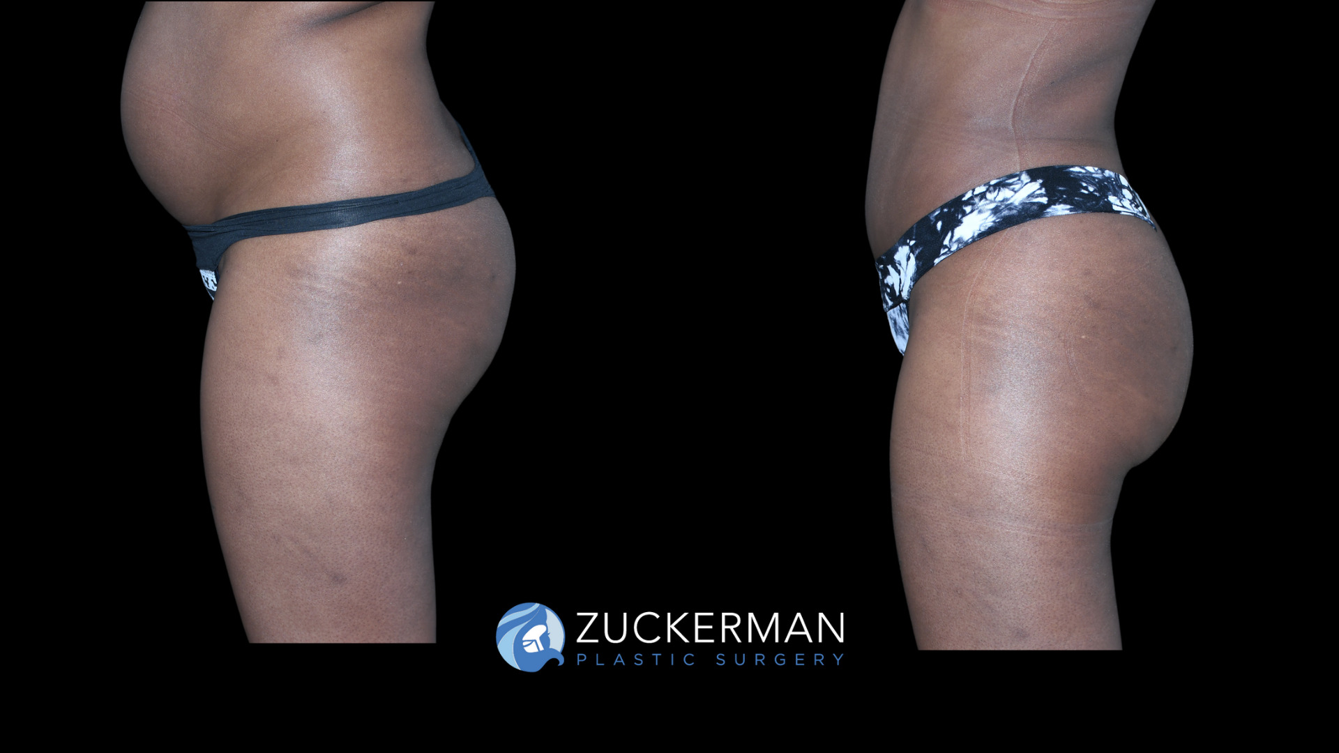 Patient before and after Lipo 360 & Brazilian Butt Lift | Zuckerman Plastic Surgery