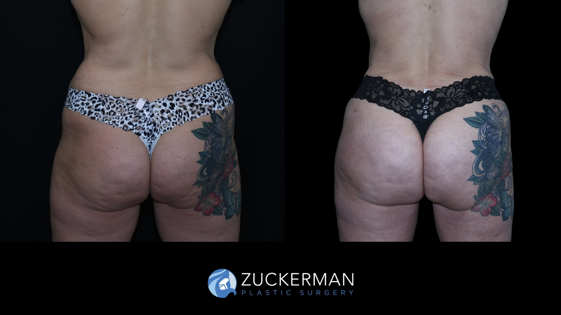 Patient results before and after Brazilian Butt Lift (BBL) performed by Dr. Zuckerman, showing improved contour and volume of the buttocks, front view.