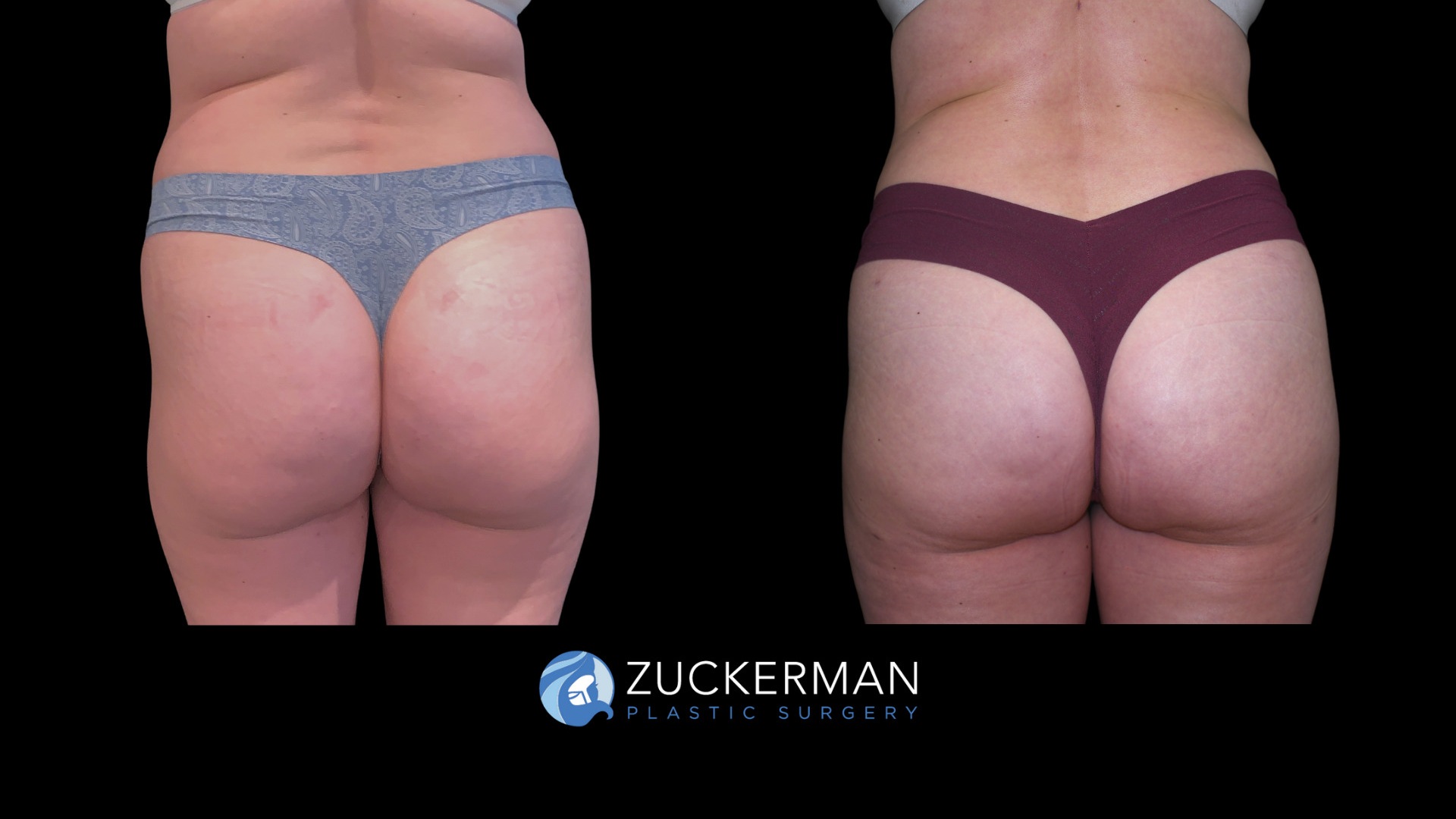 Patient before and after Lipo 360 & Brazilian Butt Lift | Zuckerman Plastic Surgery