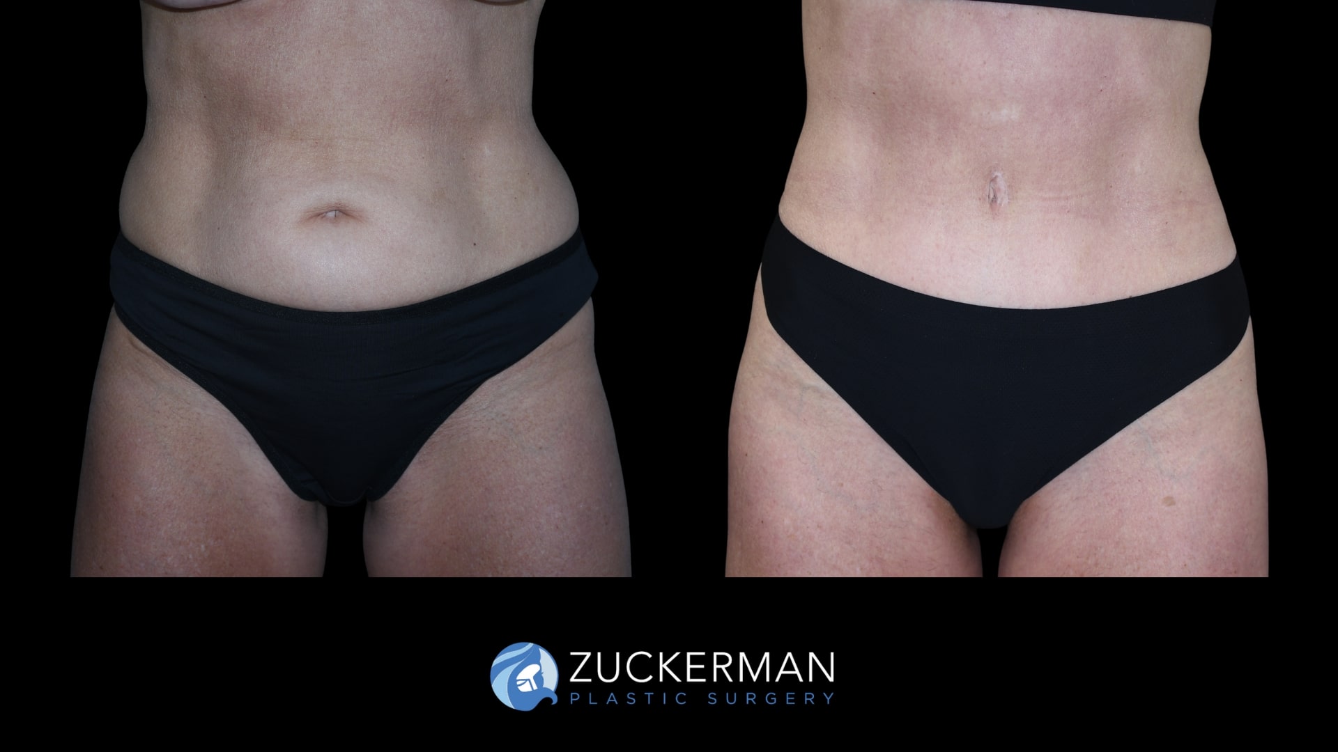Patent before and after Tummy Tuck, Back Liposuction and Buttock Augmentation| Zuckerman Plastic Surgery