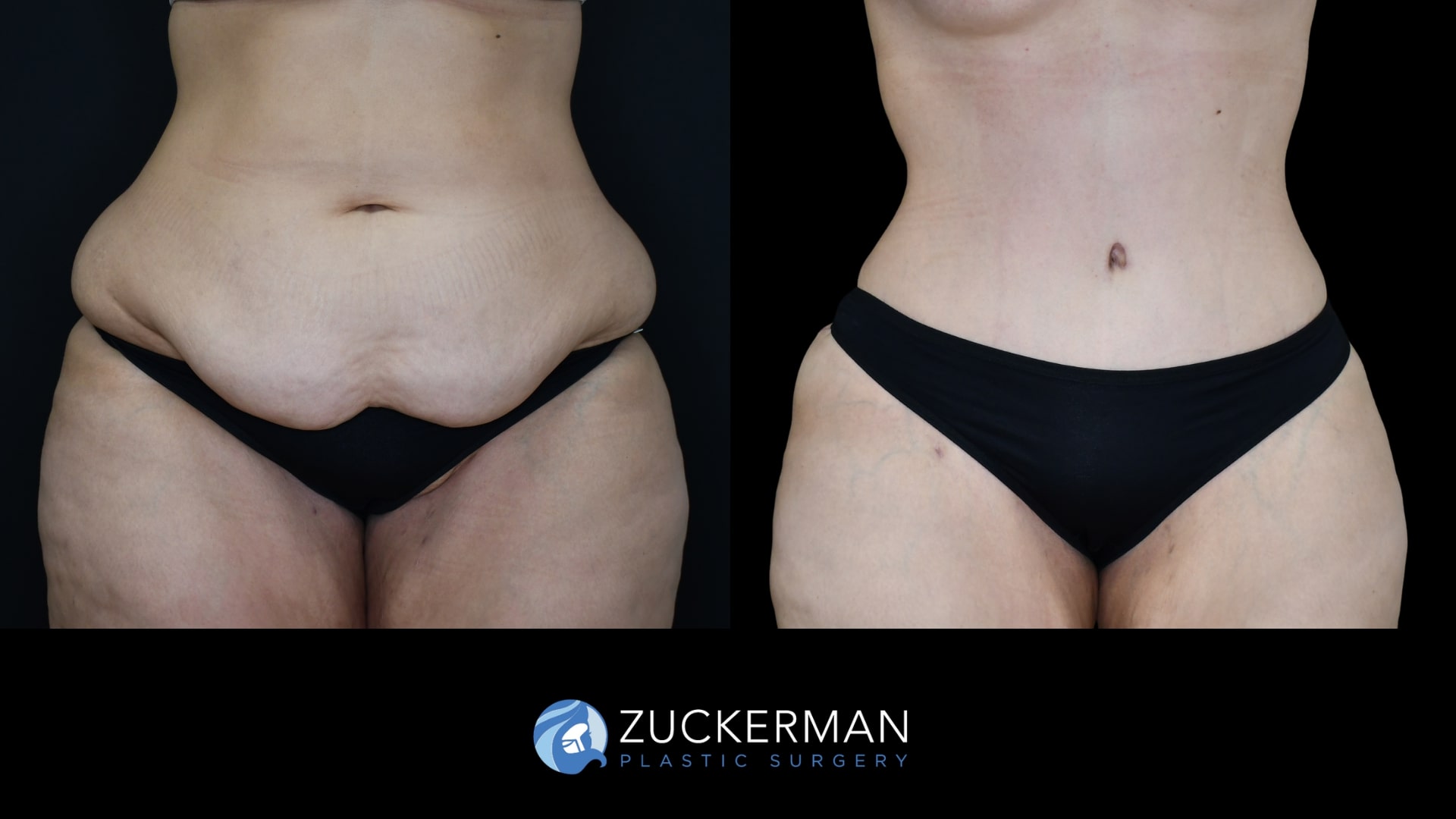 Patient before and after Tummy Tuck (Abdominoplasty) by Dr. Zuckerman.