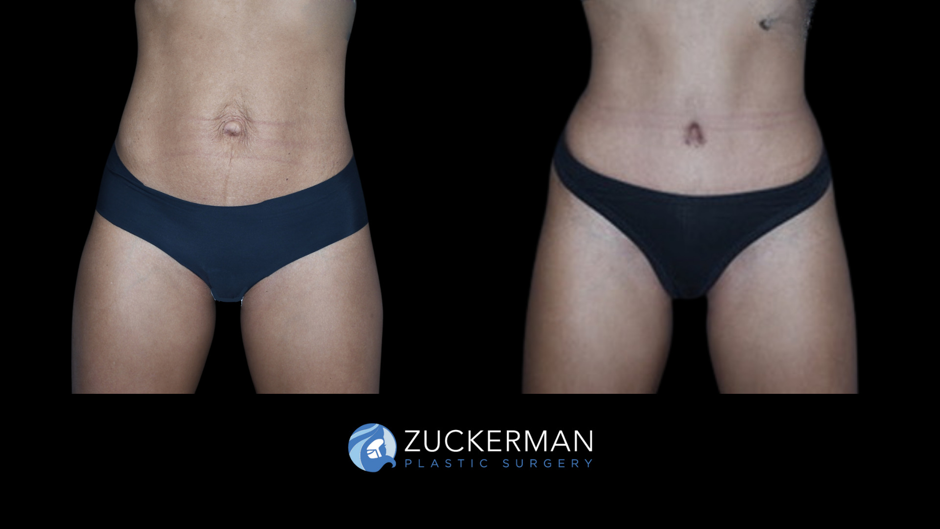 Patient before and after Tummy Tuck | Zuckerman Plastic Surgery