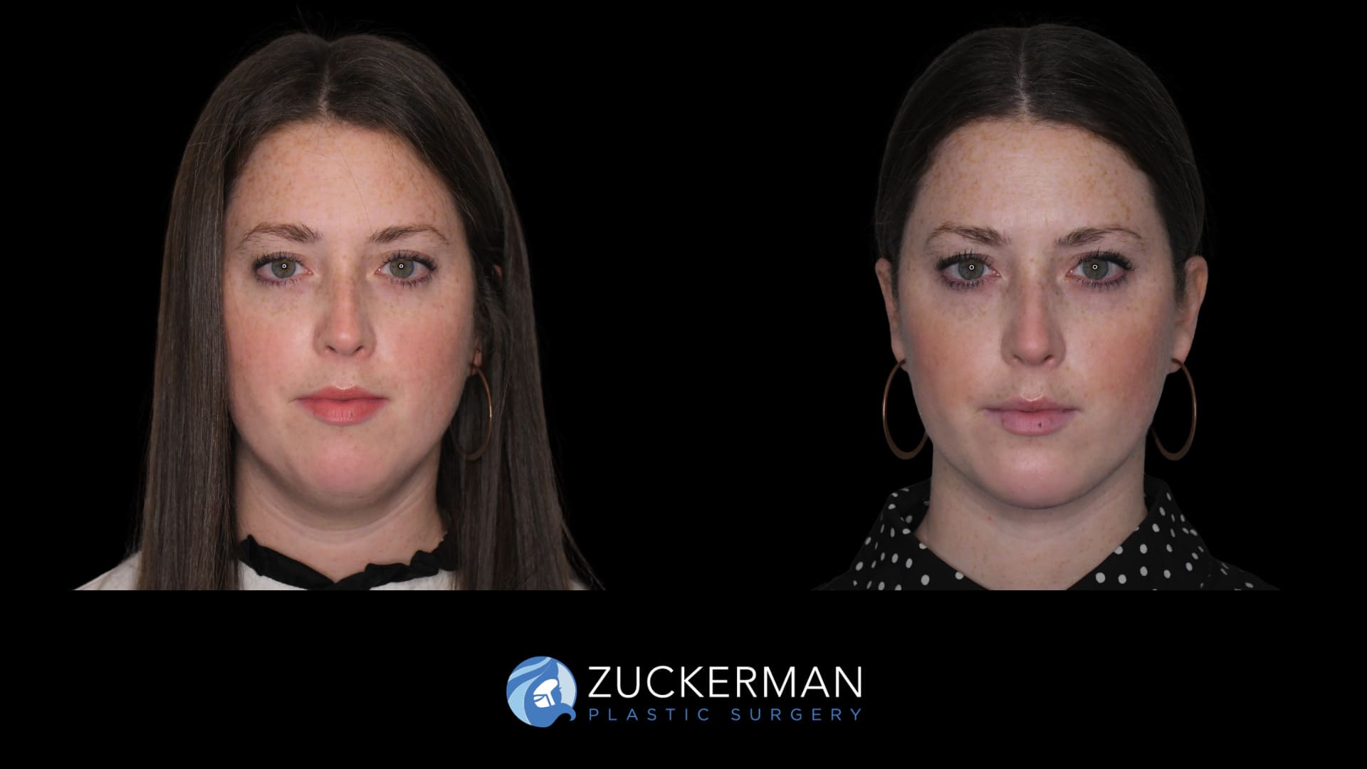 Female patient before and after chin implant and submental lipo, front view