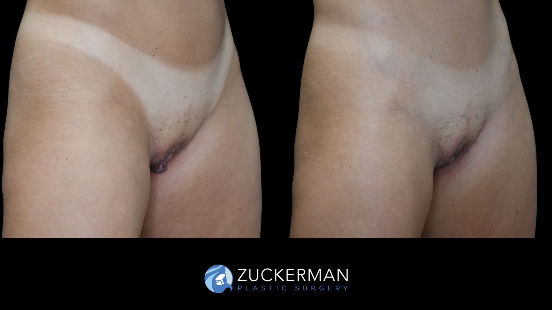 patient before and after labiaplasty, right oblique view