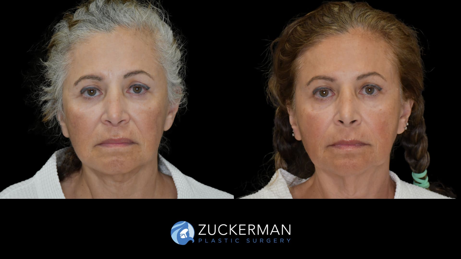 female patient before and after facelift, front view