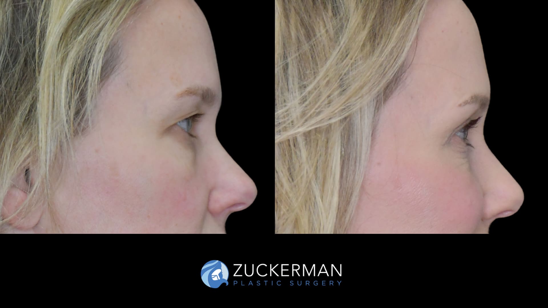 female patient before and after upper blepharoplasty and CO2 laser resurfacing of the face and neck, right side view