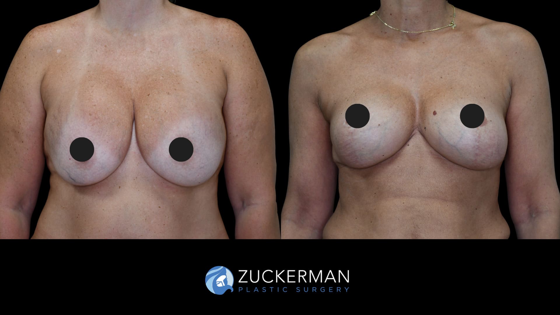 patient before and after implant exchange, front view