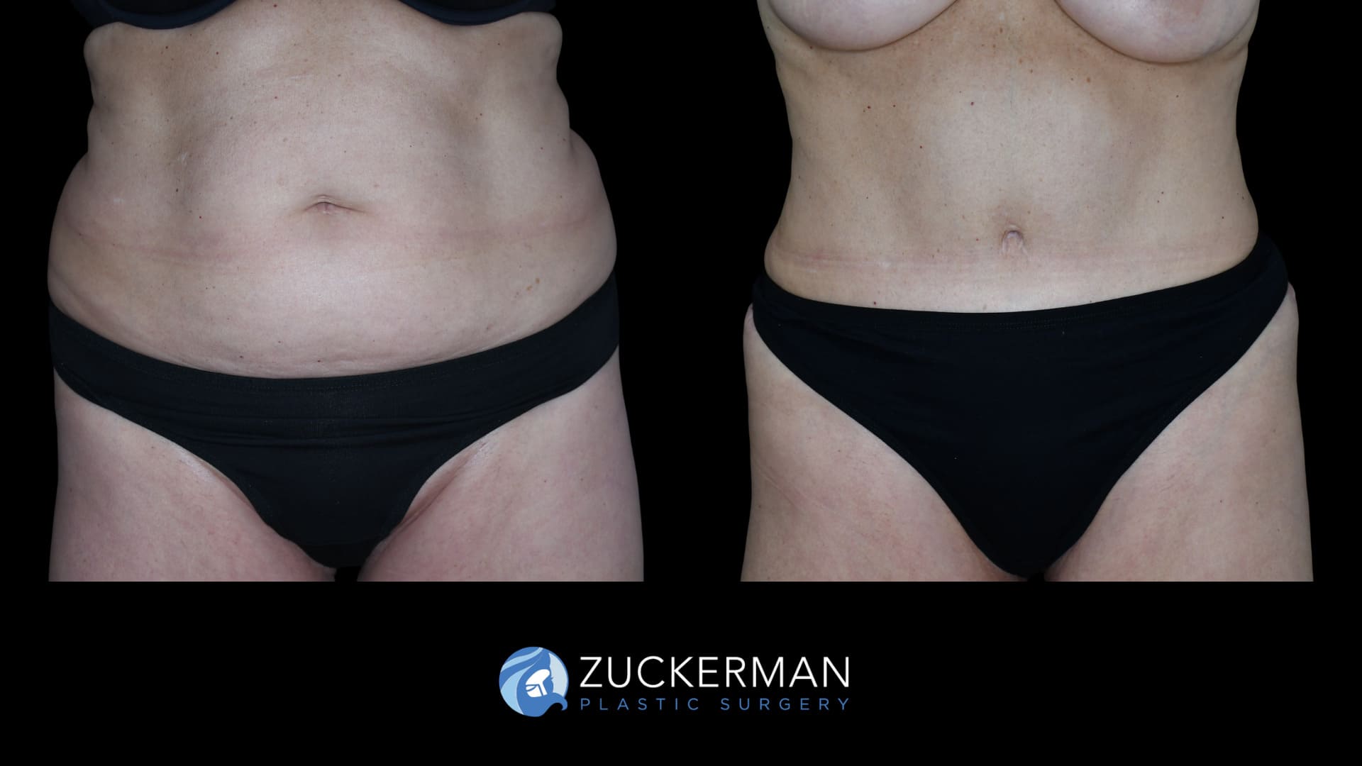famel patient before and after tummy tuck, front view