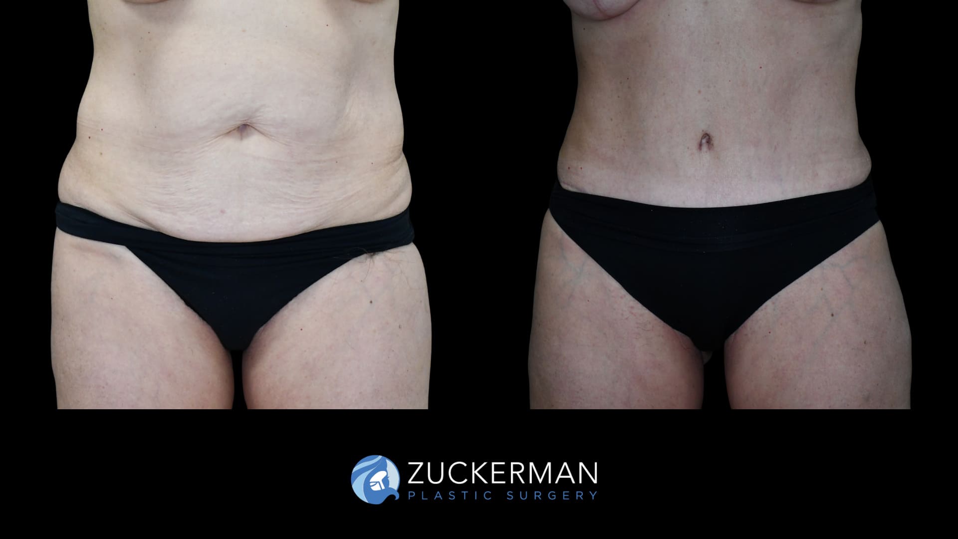 female patient before and after tummy tuck, front view