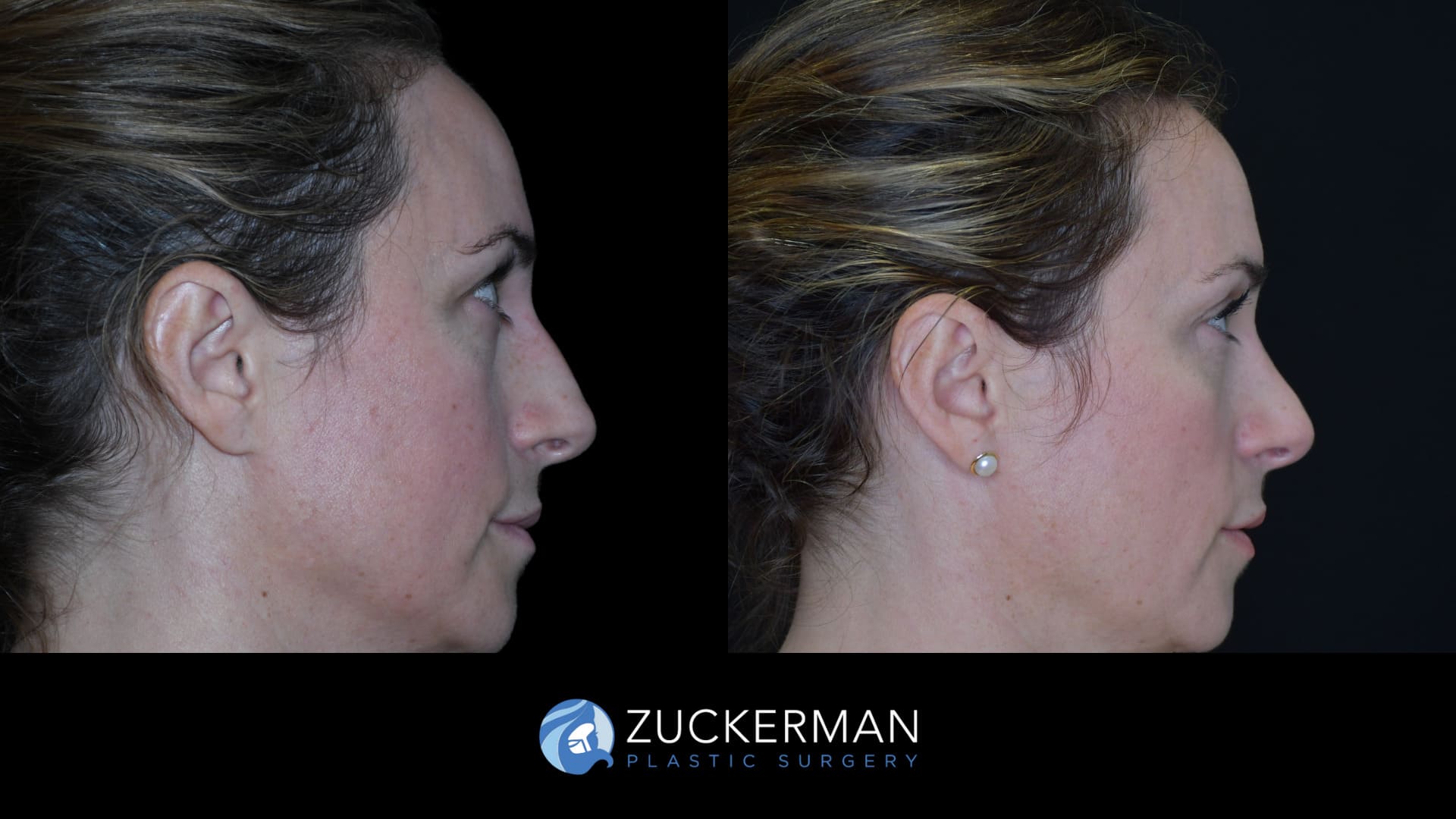 Patient before and after upper eyelid surgery (blepharoplasty) by Dr. Zuckerman, showing lifted and rejuvenated eyelids.