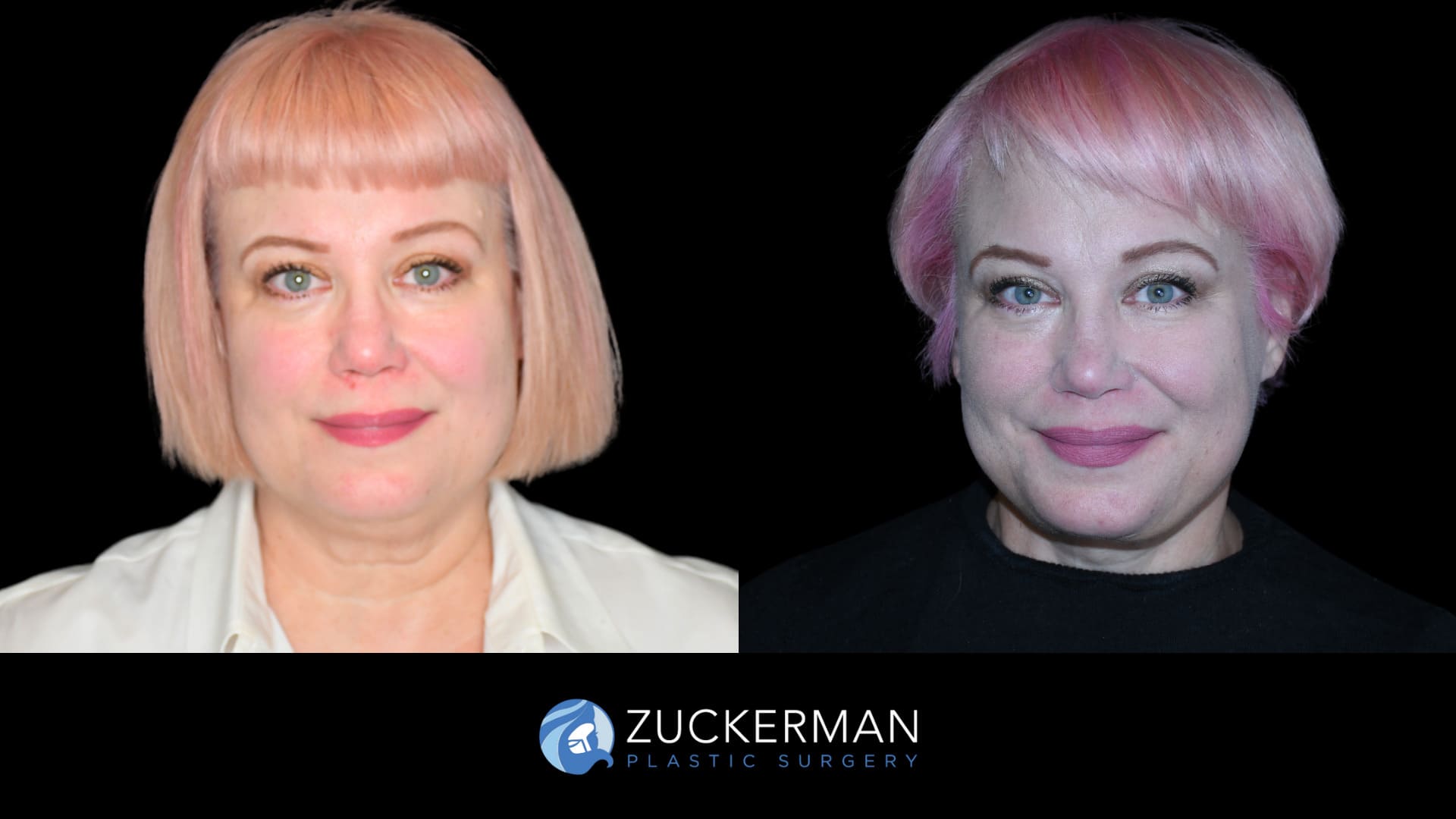 Patient results before and after facelift performed by Dr. Zuckerman, showing a smoother and more youthful facial appearance, front view.