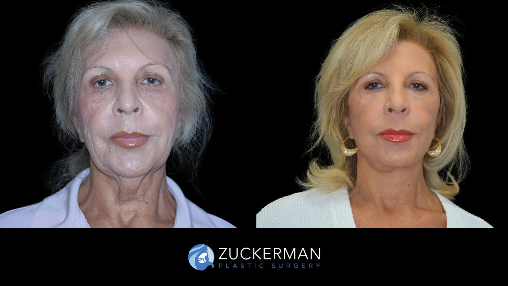 Patient results before and after face and neck lift performed by Dr. Zuckerman, showing a more defined jawline and smoother neck appearance, front view.