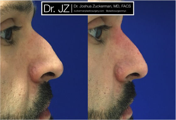 Non-surgical rhinoplasty by Dr. Zuckerman. Patient, male. Treatment reduces the prominence of dorsal hump. Juvederm Ultra Plus injected above and below the hump. Images taken day of treatment. right profile