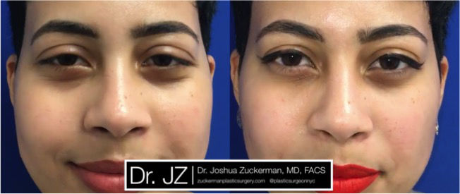 Tear trough rejuvenation using Restylane-L by Dr. Zuckerman. Patient, female, day of treatment. Treated used to fill in dark circles / restore a tired appearance. 1cc of Restylane-L with lidocaine injected per eye. frontal