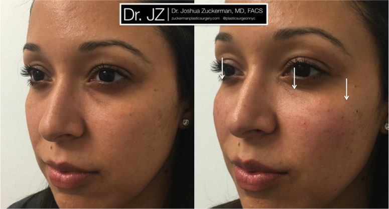 Cheek enhancement using Voluma by Dr. Zuckerman. Patient, female, day of treatment. Restore cheek roundness / youthfulness lost due to flattening and midface descent due to aging. One vial (1cc) injected total. Treatment result is subtle, so arrows are provided. frontal