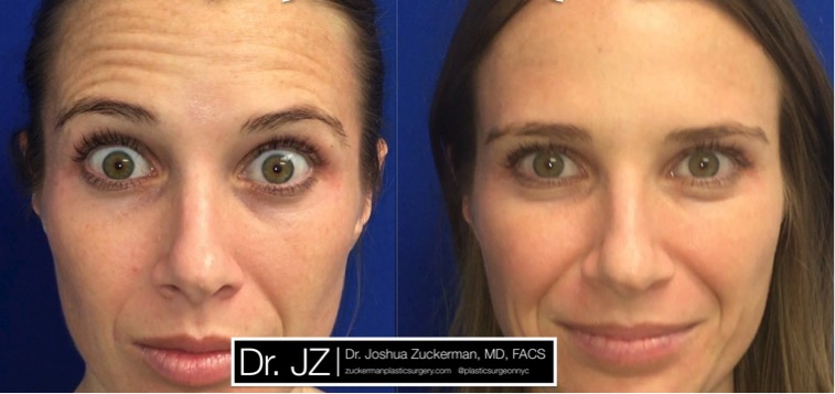 A patient of Dr. Zuckerman’s in New York City who underwent forehead treatment with Botox Cosmetic, a similar musculoparalytic injectable to Dysport. Patient treated with 13 units in corrugator muscles, 2 units in procerus muscles, 10 units in upper forehead. Images taken just prior to treatment and then seven days afterward.