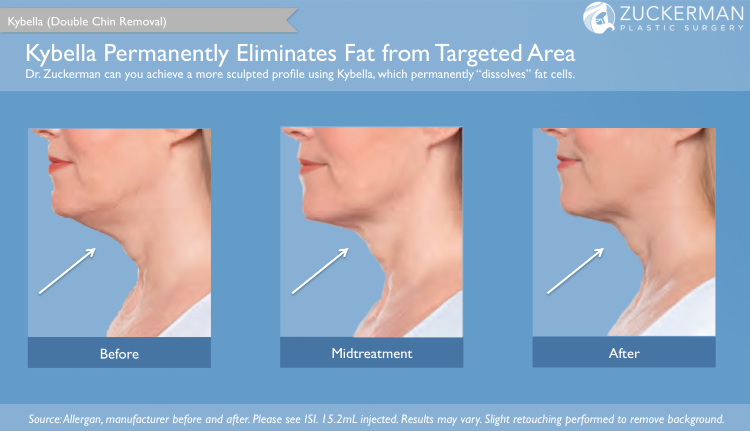 Kybella permanently addresses a double chin (submental fullness) by destroying fat cells. This is an Allergan patient before and after. Individual results may vary.