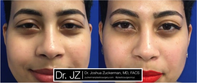 tear trough rejuvenation 1 frontal