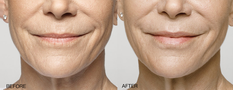 restylane silk galderma before after small
