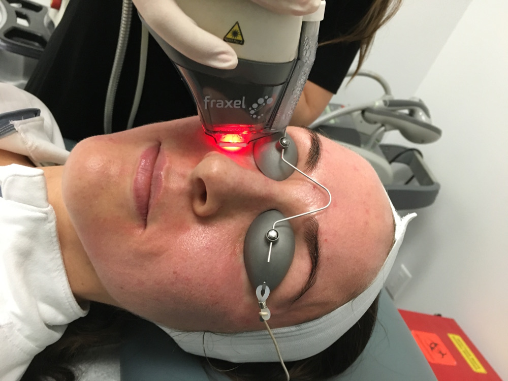 Dr. Zuckerman performs a laser skin resurfacing treatment for a patient using the Fraxel laser in his office in New York City.