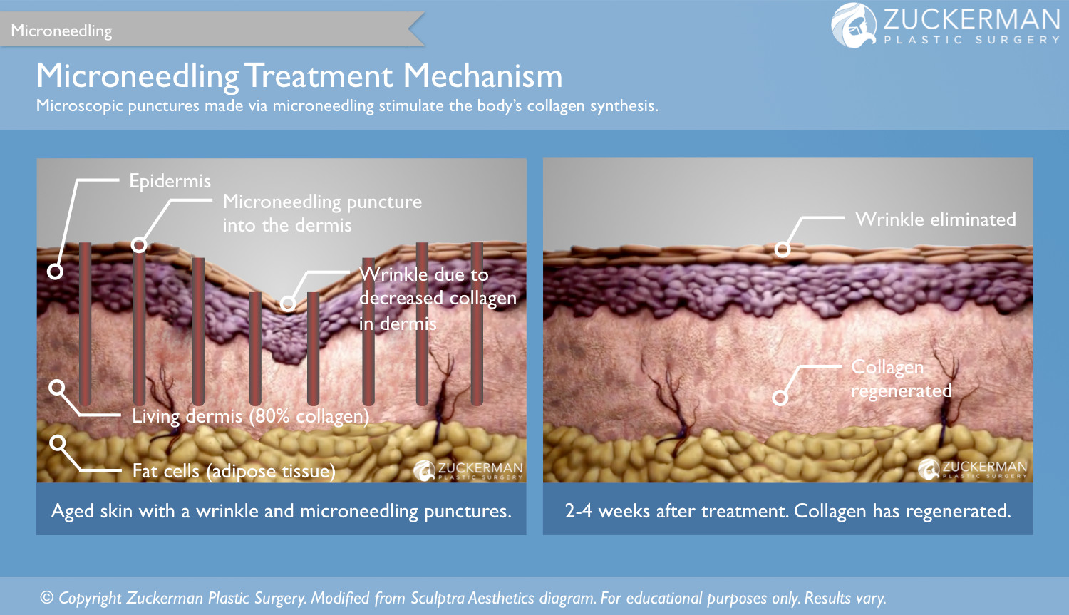 microneedling mechanism wrinkle elimination