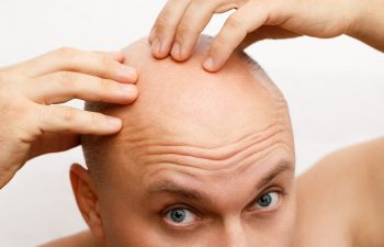 The Head Of A Balding Man. A Bald Man Was Upset Because Of The H