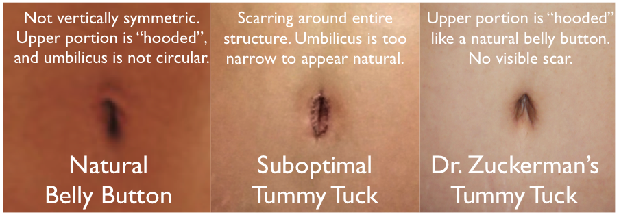 What Will Happen to My Belly Button During a Tummy Tuck