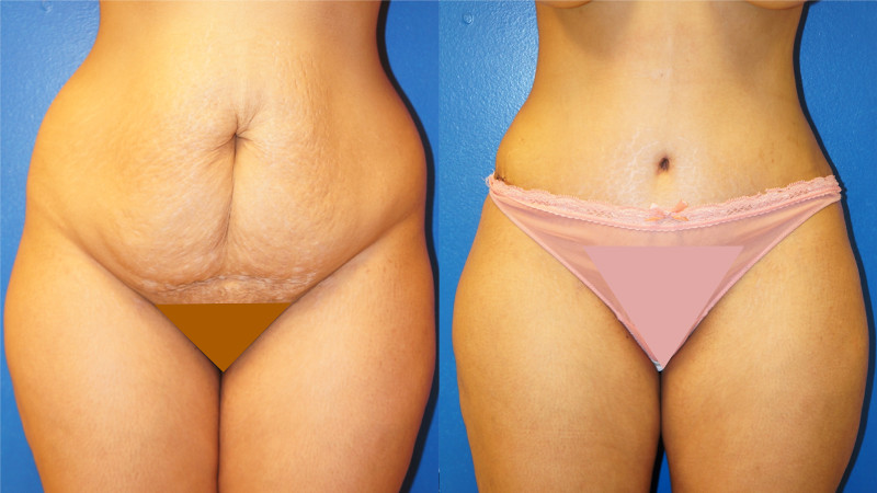 From dodgy filler to a near-fatal tummy tuck — plastic surgery ruined our  lives – The US Sun