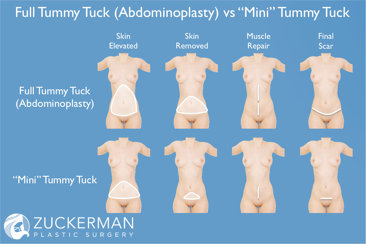 Mini Abdominoplasty, Mini Tummy Tuck