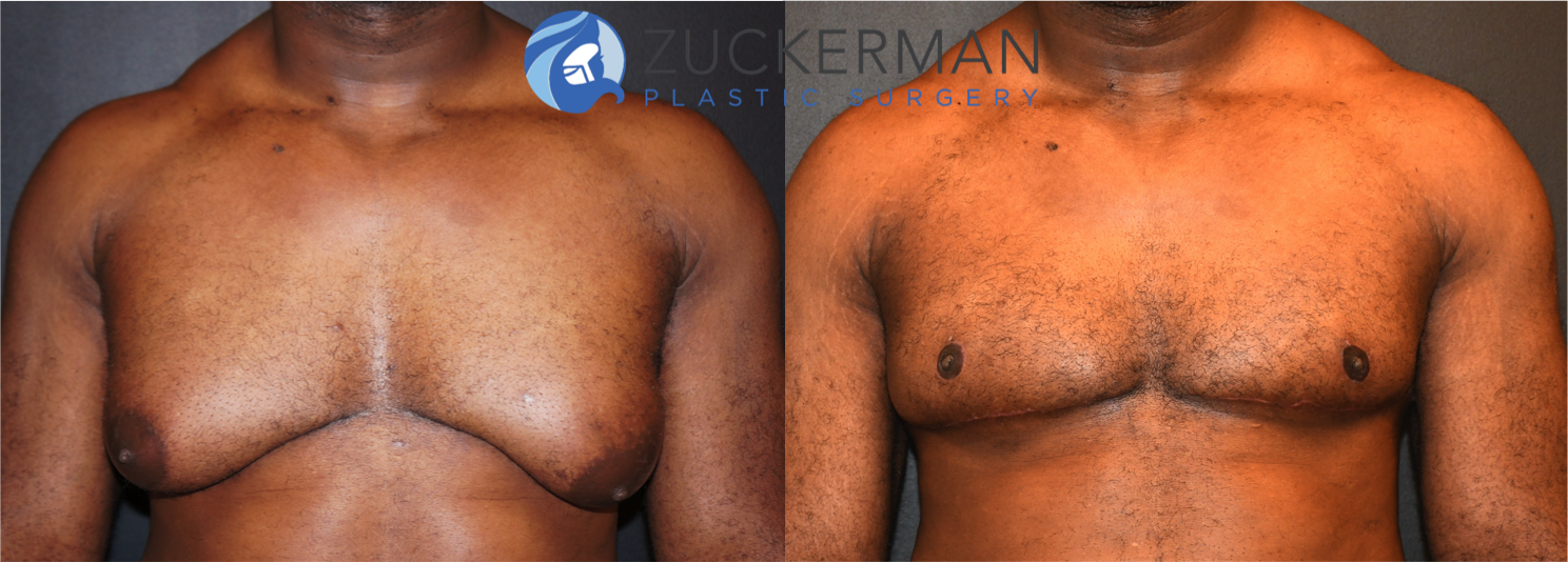 Breast Lift NYC – Top Ranked Zuckerman Plastic Surgery