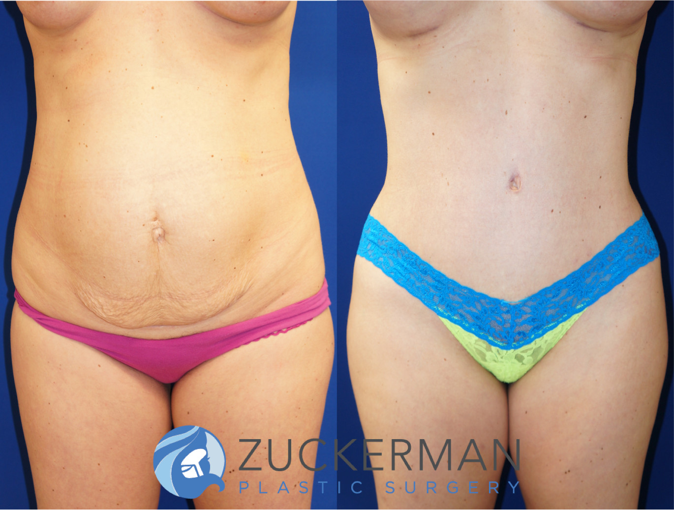 Tummy Tuck NYC Plastic Surgery Complete Guide - Manhattan