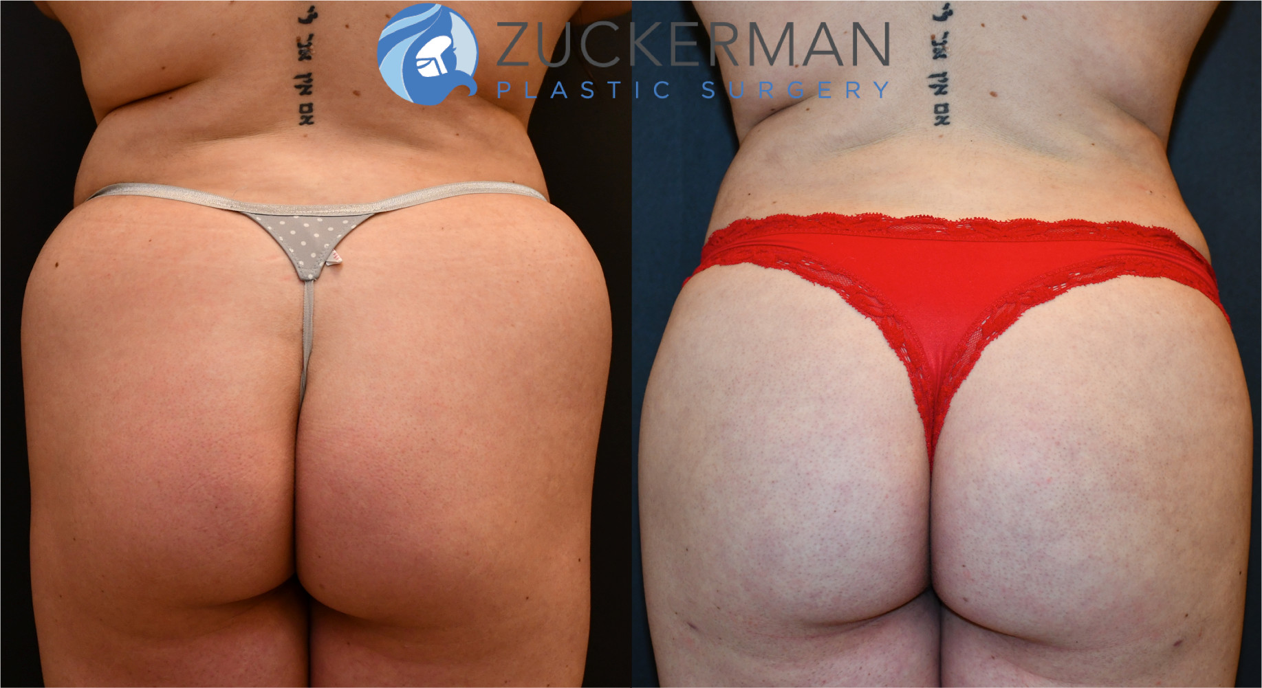 Surprising Facts about Brazilian Butt Lift - NYC