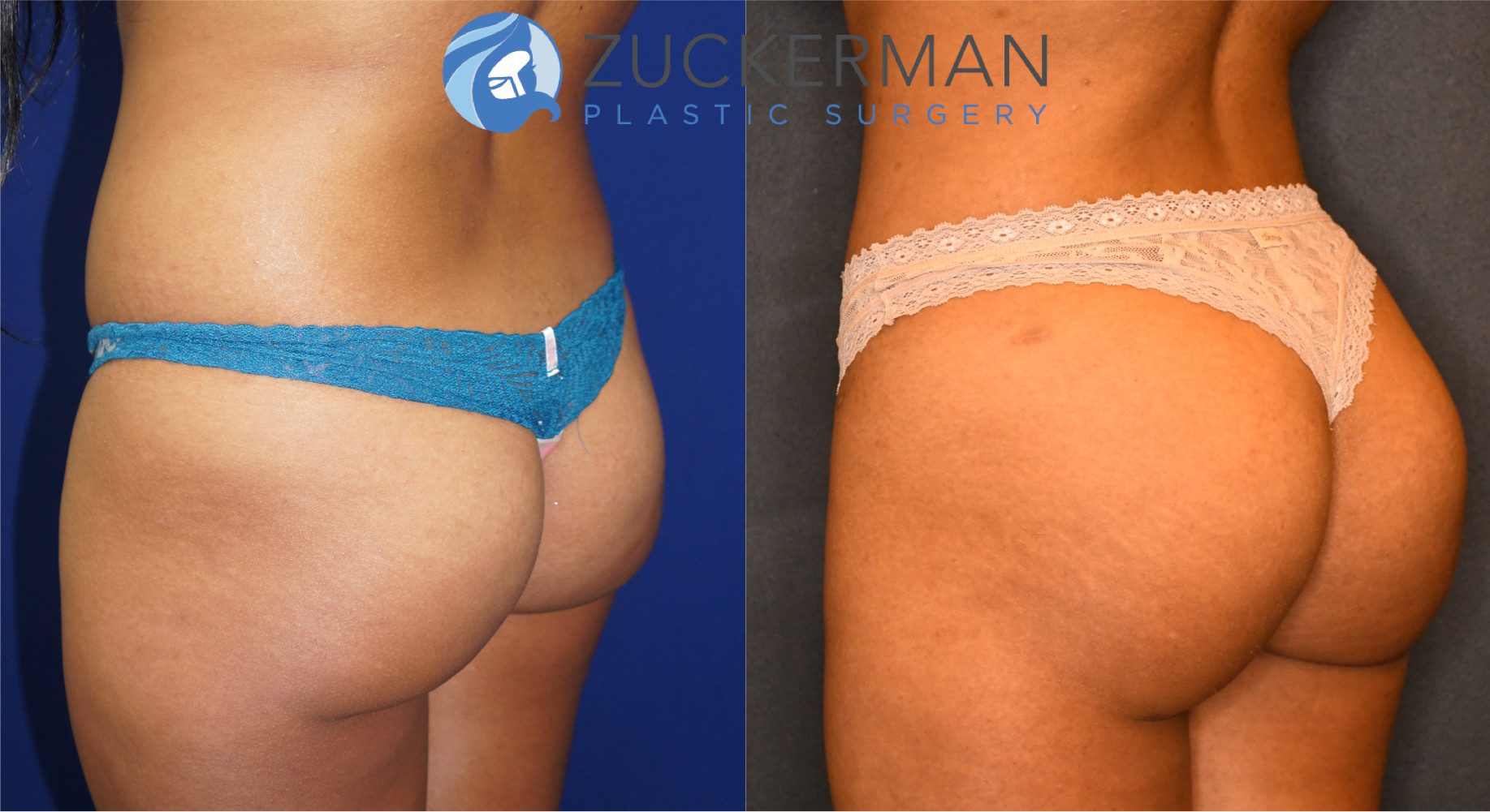 Should i get butt implants before or after fat grafting to the buttocks? -  Plastic Surgeon