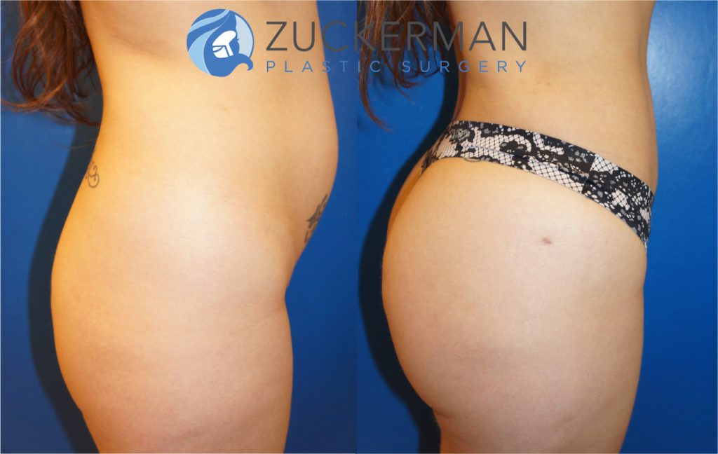 Buttock augmentation, or Brazilian Butt Lift (BBL), by Dr. Zuckerman. Patient, female, 3 months postop. 1.5 liters of fat removed from abdomen, flanks, and lower back. 580cc of fat grafted to each buttock. right profile