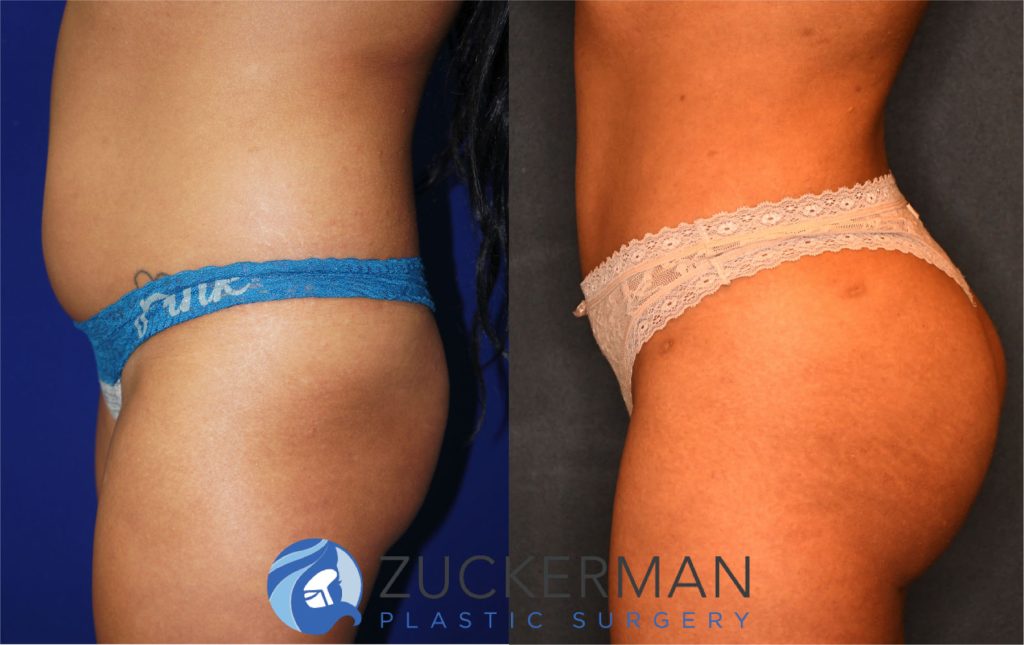 Buttock augmentation, or Brazilian Butt Lift (BBL), by Dr. Zuckerman. Patient, female, 3 months postop. 3 liters of fat removed from abdomen, flanks, and lower back. 600cc of fat grafted to each buttock. left oblique