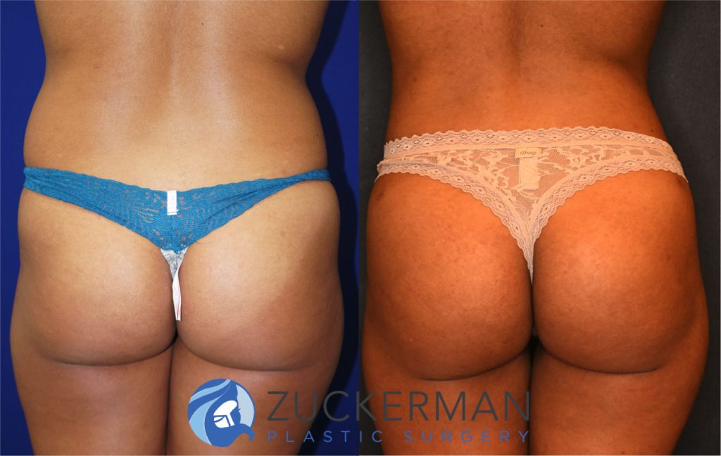 Buttock augmentation, or Brazilian Butt Lift (BBL), by Dr. Zuckerman. Patient, female, 3 months postop. 3 liters of fat removed from abdomen, flanks, and lower back. 600cc of fat grafted to each buttock. posterior