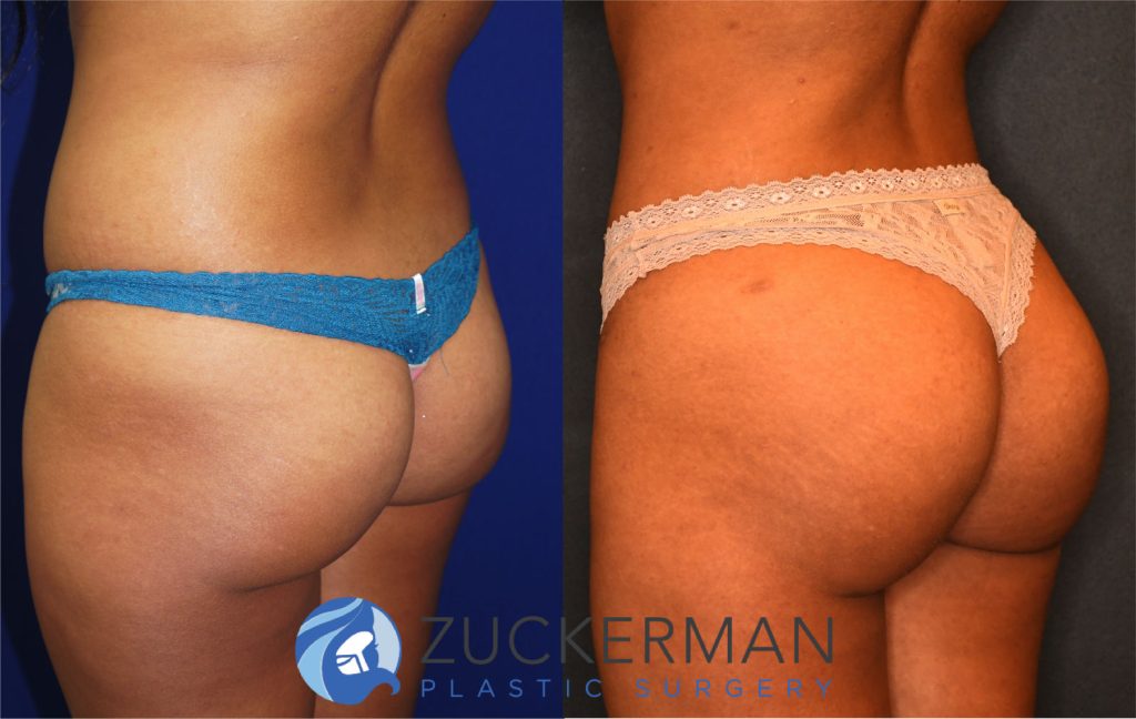 Buttock augmentation, or Brazilian Butt Lift (BBL), by Dr. Zuckerman. Patient, female, 3 months postop. 3 liters of fat removed from abdomen, flanks, and lower back. 600cc of fat grafted to each buttock. posterior left oblique