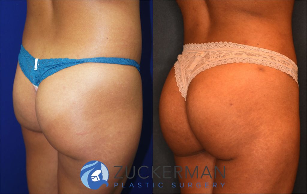 Buttock augmentation, or Brazilian Butt Lift (BBL), by Dr. Zuckerman. Patient, female, 3 months postop. 3 liters of fat removed from abdomen, flanks, and lower back. 600cc of fat grafted to each buttock. posterior right oblique