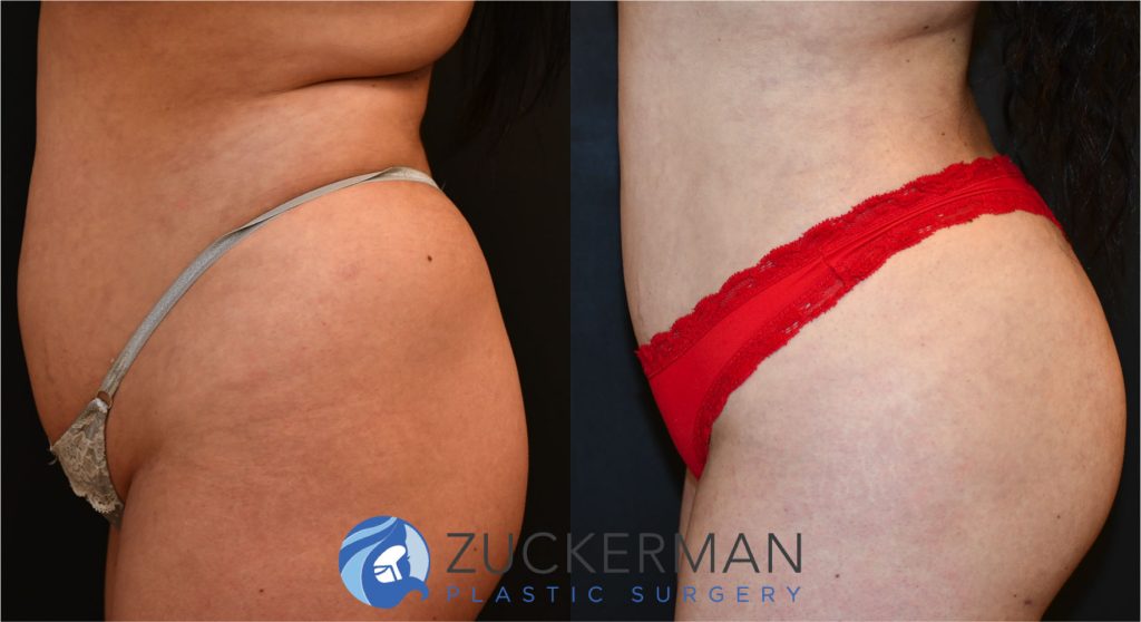 Buttock augmentation, or Brazilian Butt Lift (BBL), by Dr. Zuckerman. Patient, female, 2 months postop. 3 liters of fat removed from abdomen, flanks, and lower back. 750cc of fat grafted to each buttock. left profile