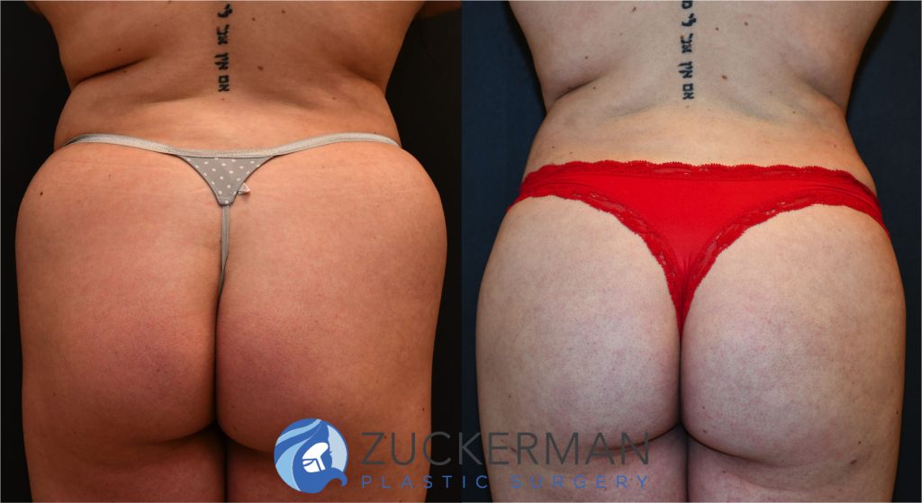 Buttock augmentation, or Brazilian Butt Lift (BBL), by Dr. Zuckerman. Patient, female, 2 months postop. 3 liters of fat removed from abdomen, flanks, and lower back. 750cc of fat grafted to each buttock. posterior