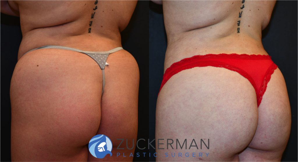 Buttock augmentation, or Brazilian Butt Lift (BBL), by Dr. Zuckerman. Patient, female, 2 months postop. 3 liters of fat removed from abdomen, flanks, and lower back. 750cc of fat grafted to each buttock. posterior left oblique