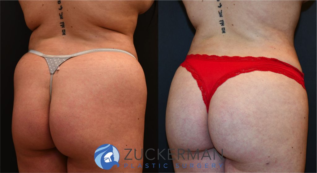 Buttock augmentation, or Brazilian Butt Lift (BBL), by Dr. Zuckerman. Patient, female, 2 months postop. 3 liters of fat removed from abdomen, flanks, and lower back. 750cc of fat grafted to each buttock. posterior right oblique