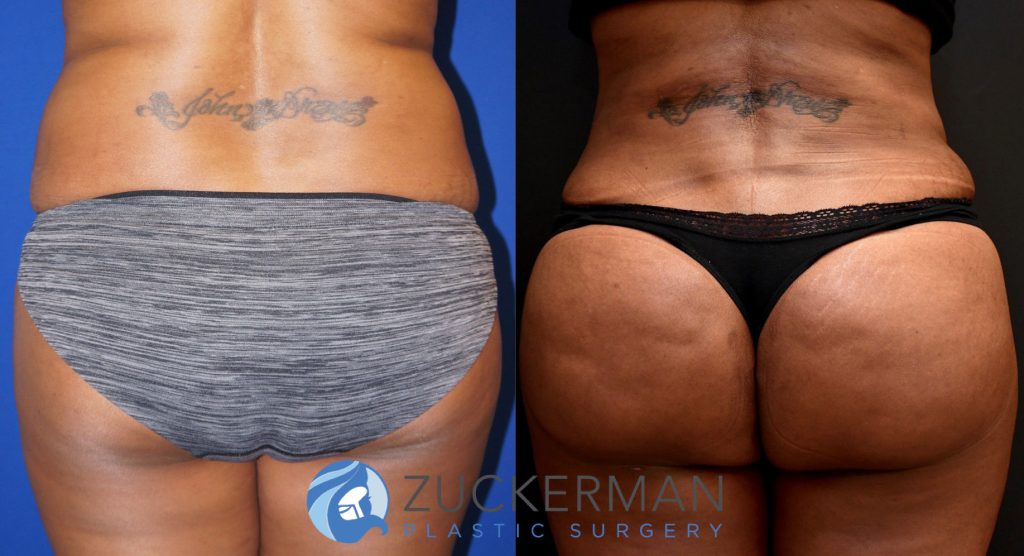 Buttock augmentation, or Brazilian Butt Lift (BBL), by Dr. Zuckerman. Patient, female, 3 months postop. 3 liters of fat removed from abdomen, flanks, and lower back. 1100cc of fat grafted to each buttock. posterior