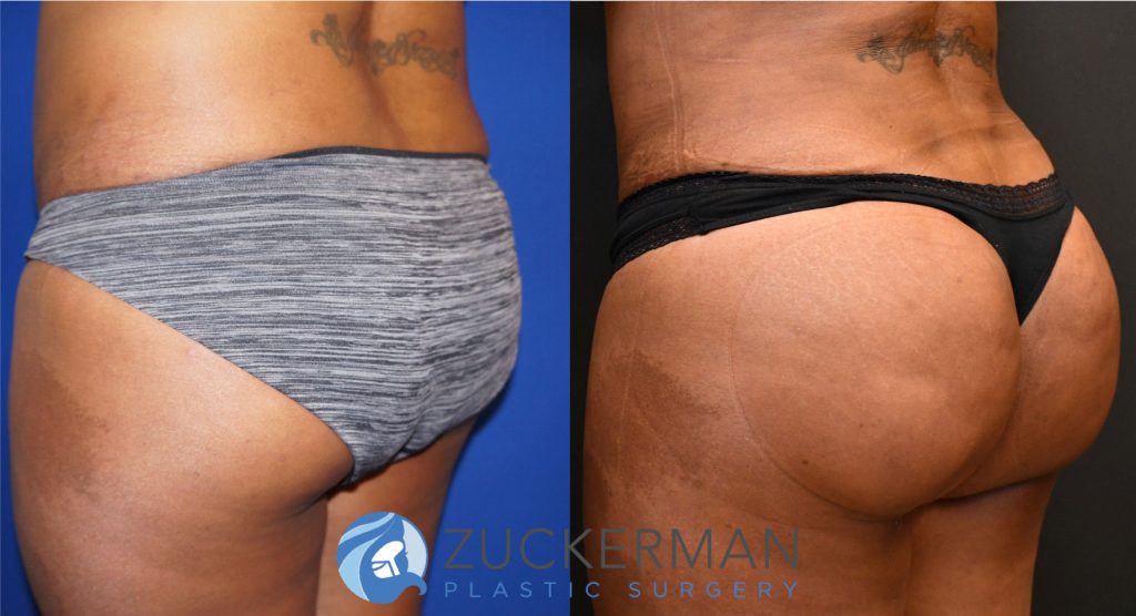 Buttock augmentation, or Brazilian Butt Lift (BBL), by Dr. Zuckerman. Patient, female, 3 months postop. 3 liters of fat removed from abdomen, flanks, and lower back. 1100cc of fat grafted to each buttock. left oblique