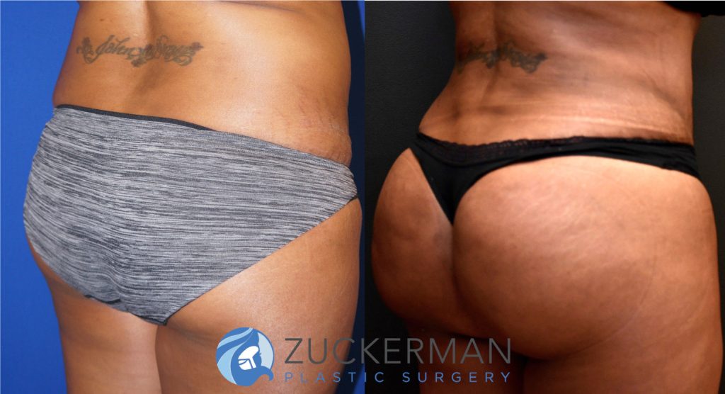 Buttock augmentation, or Brazilian Butt Lift (BBL), by Dr. Zuckerman. Patient, female, 3 months postop. 3 liters of fat removed from abdomen, flanks, and lower back. 1100cc of fat grafted to each buttock. right oblique